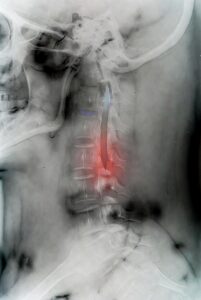 Spinal Cord Injury
